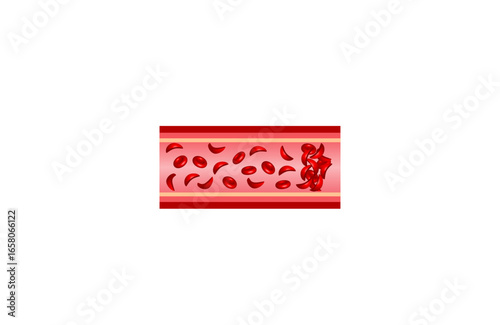 Sickle cell disease. Normal blood and Sickle cell anemia,. Gene mutation. Vector illustration.	