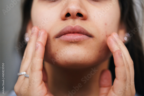 A young woman gently touches her face, revealing visible acne and skin blemishes. This close-up highlights common dermatological concerns and skin care needs.