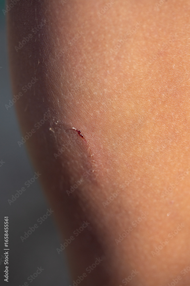 Fototapeta premium Close-up of bleeding wound on human skin showing health problems