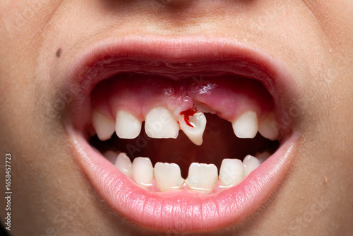 Child showing broken tooth with blood, dental trauma and toothache