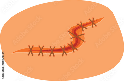 Surgical suture closing a wound with stitches on skin, healthcare and first aid concept