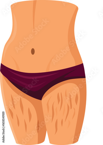 Female body with stretch marks on thighs, concept of body positivity and acceptance