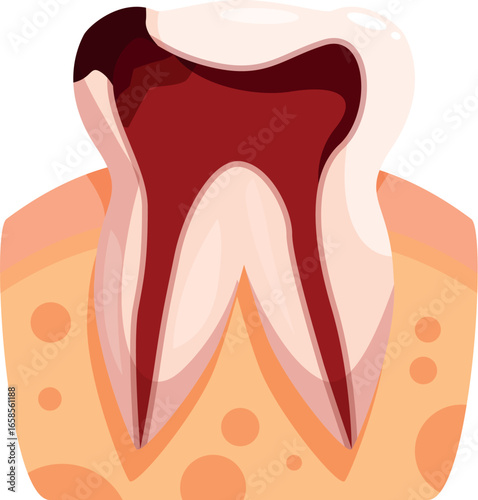 Tooth decay reaching the pulp and requiring root canal treatment