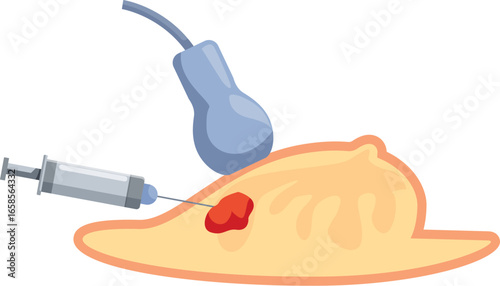 Medical procedure involving ultrasound guided biopsy and syringe injection