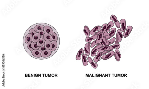 Vector illustrations of malignant and benign tumors in body tissues. Spread of cancer cells. Medical vector illustrations for education, posters, clinics, and science.