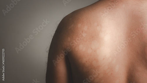 Wallpaper Mural Skin fungus, ringworm, possibly caused by fungal infection or vitiligo. High-resolution medical or dermatological reference for healthcare and skin care awareness. Torontodigital.ca