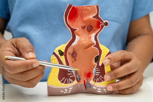 Tableau sur toile Asian doctor with rectum and hemorrhoid human anatomy model at hospital, inflamed vascular structure