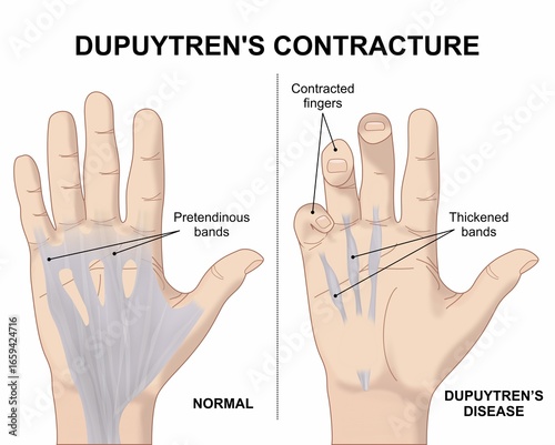 Foto Dupuytren's Contracture hand finger illustration