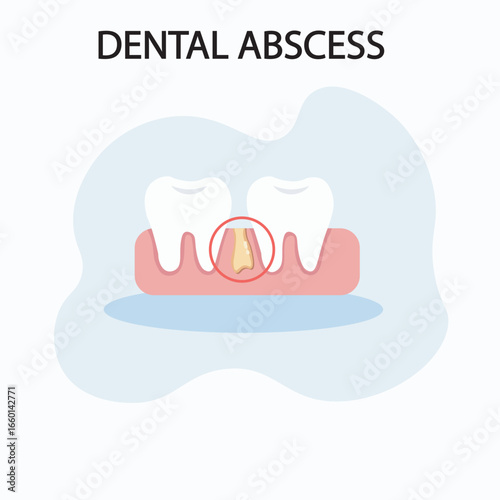 Dental abscess vector: shows swelling, severe toothache, fever, pus buildup. Highlights similar diseases like gum infection and tooth decay.icon