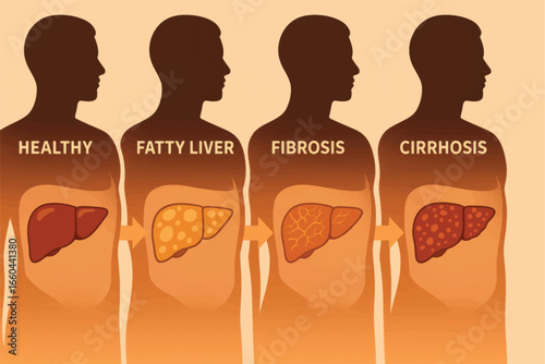 Vector illustration showing liver disease stages from healthy to cirrhosis with internal organ visuals and medical progression infographic.