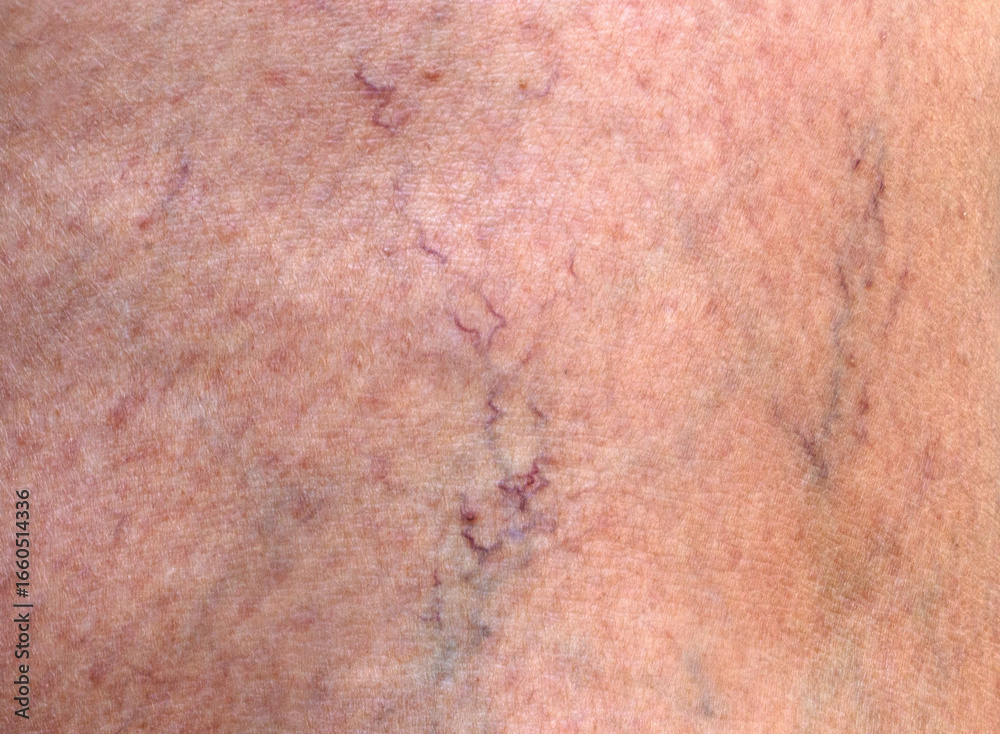 Fototapeta premium Skin with varicose veins