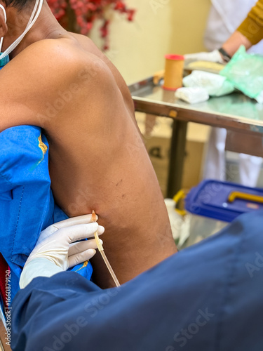 Doctor performing pleural puncture procedure on patient