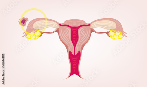 Ectopic Pregnancy concept. Vector Illustration 
