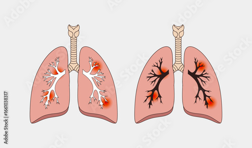 Healthy vs. Infected Lungs
Lungs with Bronchitis and Pneumonia
Lung Disease Progression
Respiratory System Health and Sickness