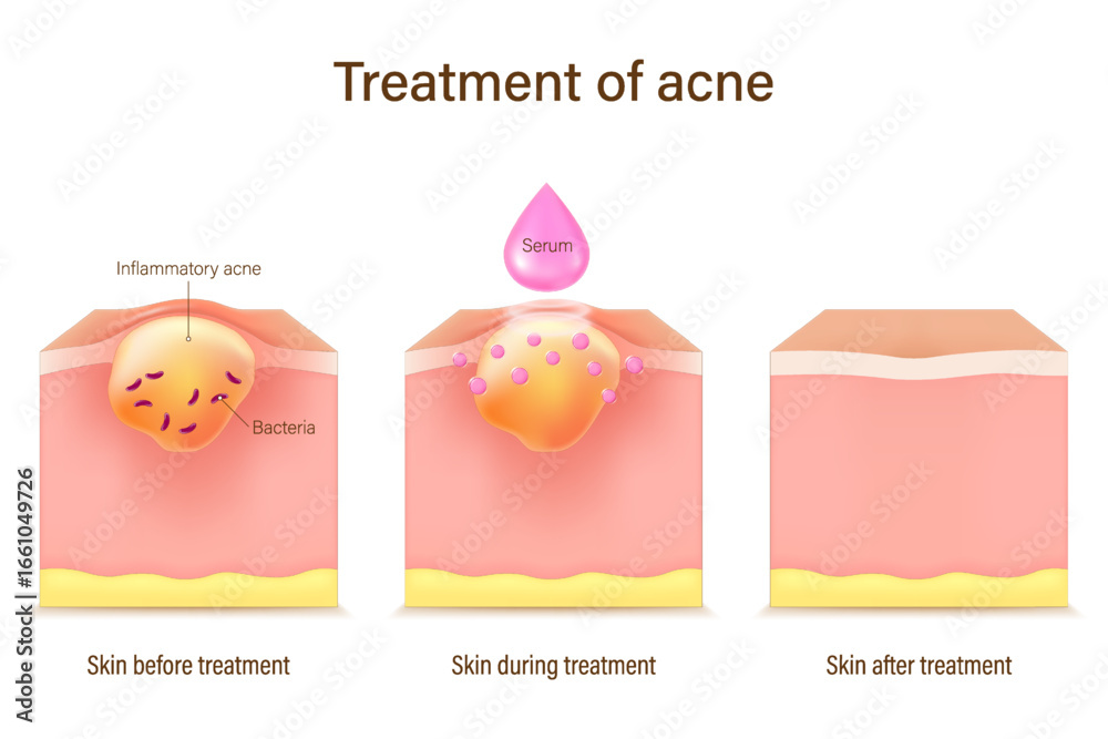 Obraz premium Treatment of acne. Skin layers before, during and after treatment. Acne skin and healthy skin. Treating acne with acne serum.