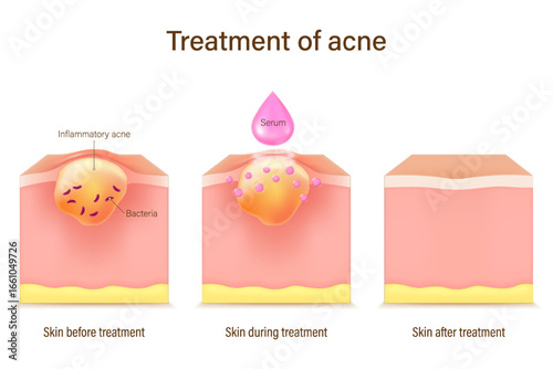 Treatment of acne. Skin layers before, during and after treatment. Acne skin and healthy skin. Treating acne with acne serum.