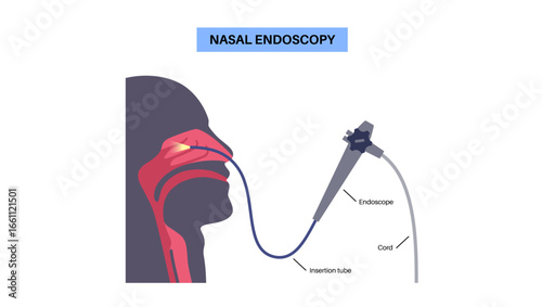 Nasal endoscopy poster