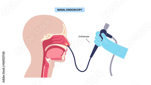 Nasal endoscopy poster