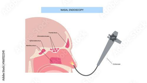 Nasal endoscopy poster
