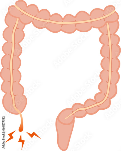 Appendicitis illustration