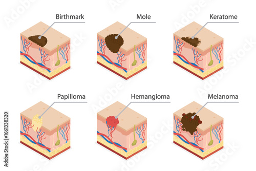 Human normal mole, birthmark, papilloma virus, hemangioma, keratome, melanoma. Human skin cross section. 3d isometric flat illustration.