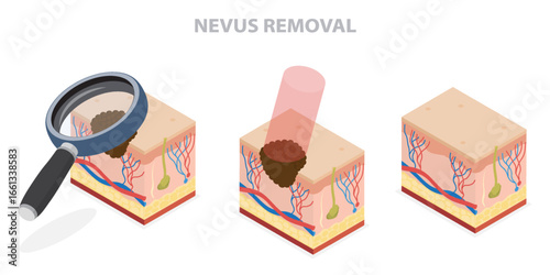 Laser remover skin lesions moles spots, nevus papillon, birthmark, melanoma, keratome, hemangioma. 3d isometric flat illustration.