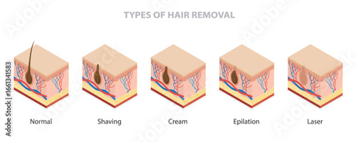 Types of hair removal. Methods of remove unwanted hair include shaving, depilatory creams, epilation and  laser. Skin care concept. 3d isometric flat illustration.
