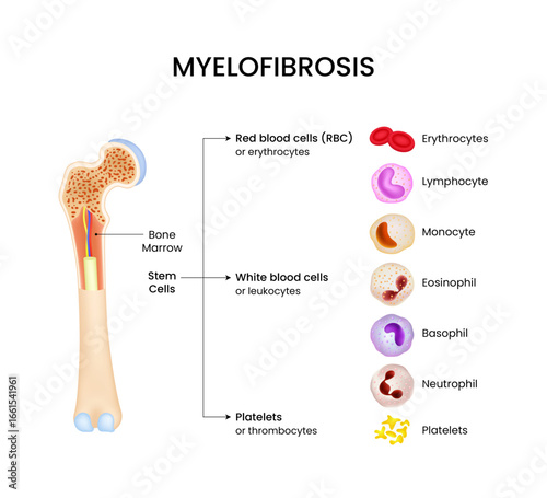 Myelofibrosis Bone Marrow and Blood Cell Anatomy