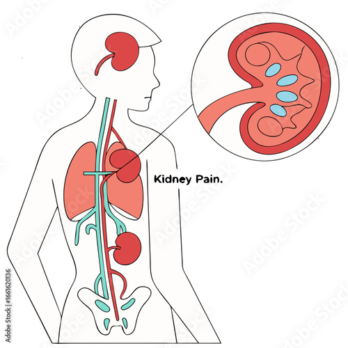 Kidney pain illustration showing human anatomy with highlighted kidneys on a white background