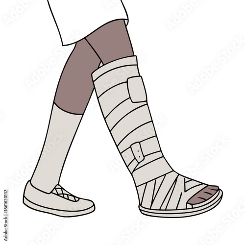 Leg in a cast walking with a supportive shoe on a clean white background