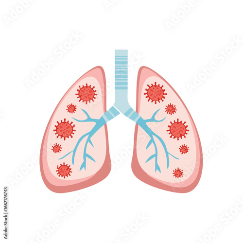 Lungs with Virus Invasion, Respiratory System Infection, Viral Attack and Pulmonary Disease