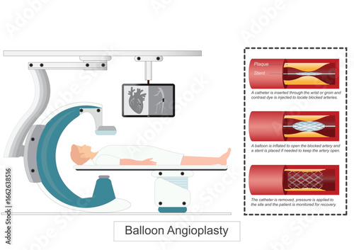 Balloon Angioplasty or Percutaneous coronary intervention (PCI)