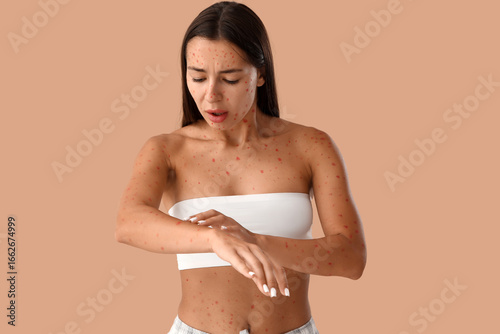 Obraz na plátně Young woman ill with chickenpox on beige background
