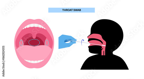 Swab throat procedure