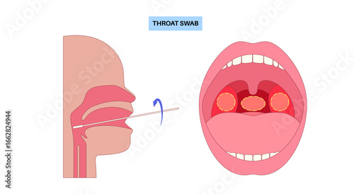 Swab throat procedure