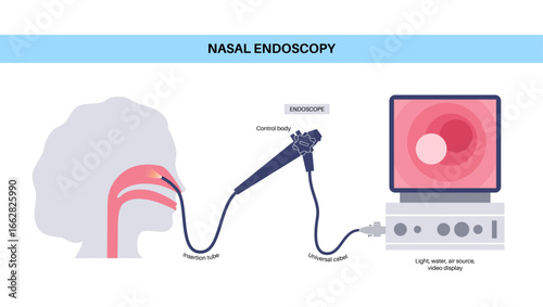 Nasal endoscopy poster