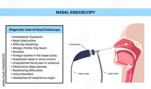 Nasal endoscopy poster