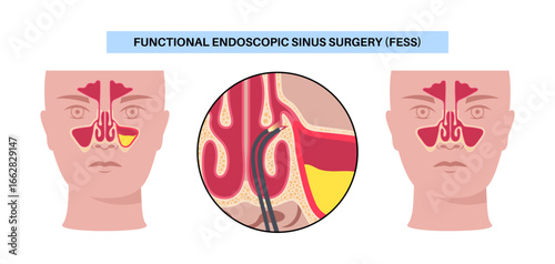 Functional Endoscopic Sinus Surgery