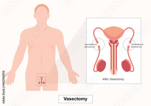 Vasectomy is a permanent surgical method of male birth control .