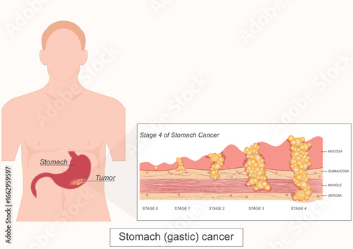 Stage4 of Stomach gastric cancer is cancer that start in the cells.
