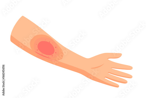Human arm with red wound injury on the forearm skin rash on arm