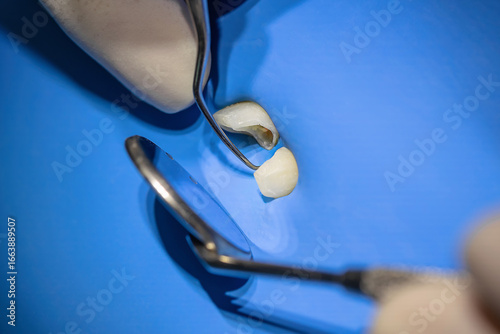 Fényképezés Detailed view of a tooth with open canals during root canal therapy