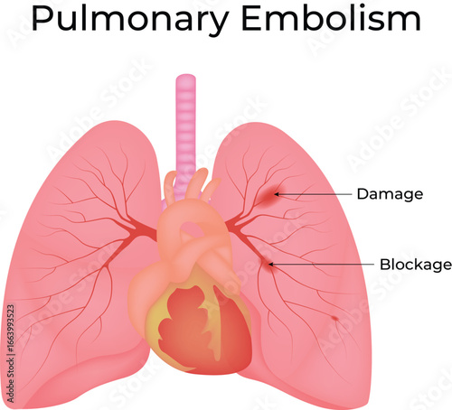 Pulmonary Embolism Anatomy and Pathology Vector Illustration
