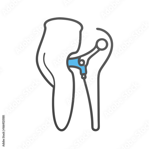 Hip replacement illustration showing prosthesis with pelvis bone
