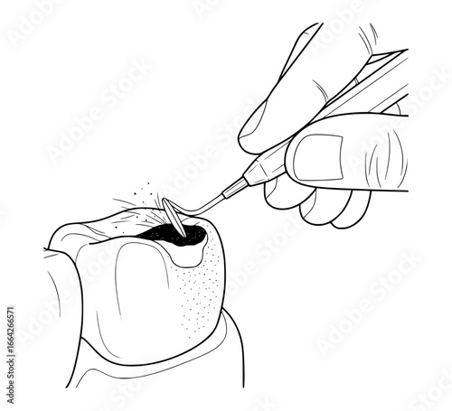 Cavities and Tooth Decay Dental Concept