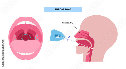 Swab throat procedure