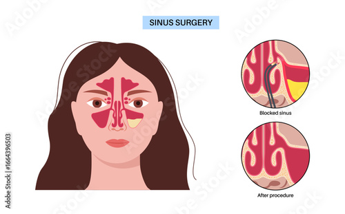 Functional Endoscopic Sinus Surgery