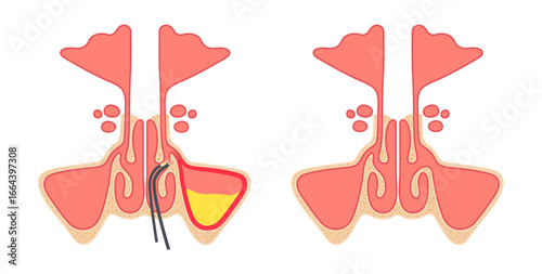 Functional Endoscopic Sinus Surgery