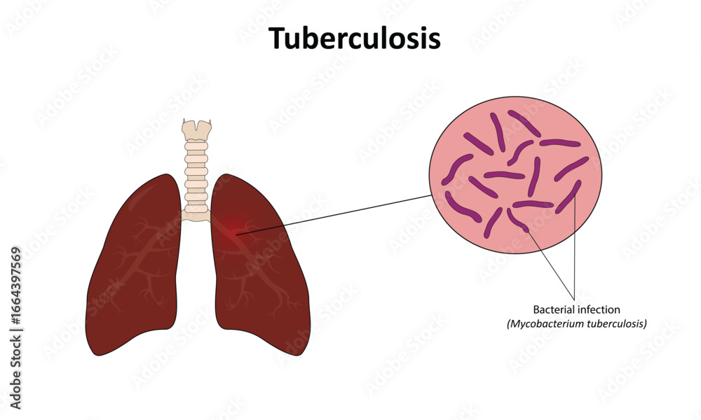 Obraz premium Tuberculosis vector illustration