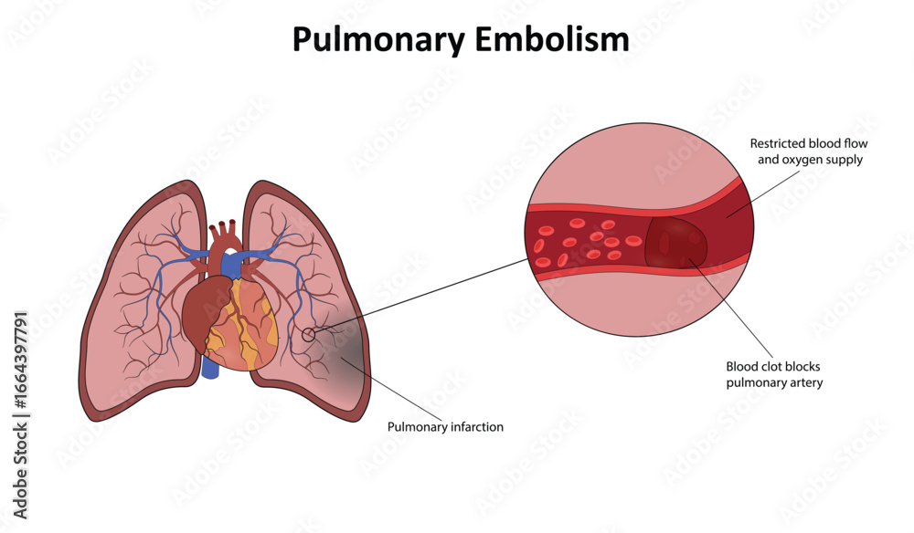 Obraz premium Pulmonary embolism vector illustration